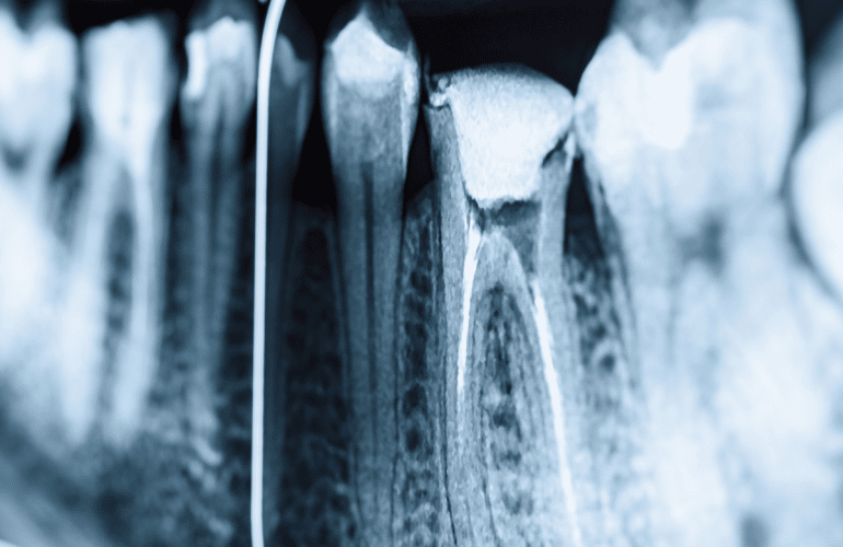 Lečenje kanala korena zuba – Endodoncija