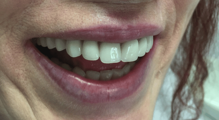 zubni implanti Beograd posle